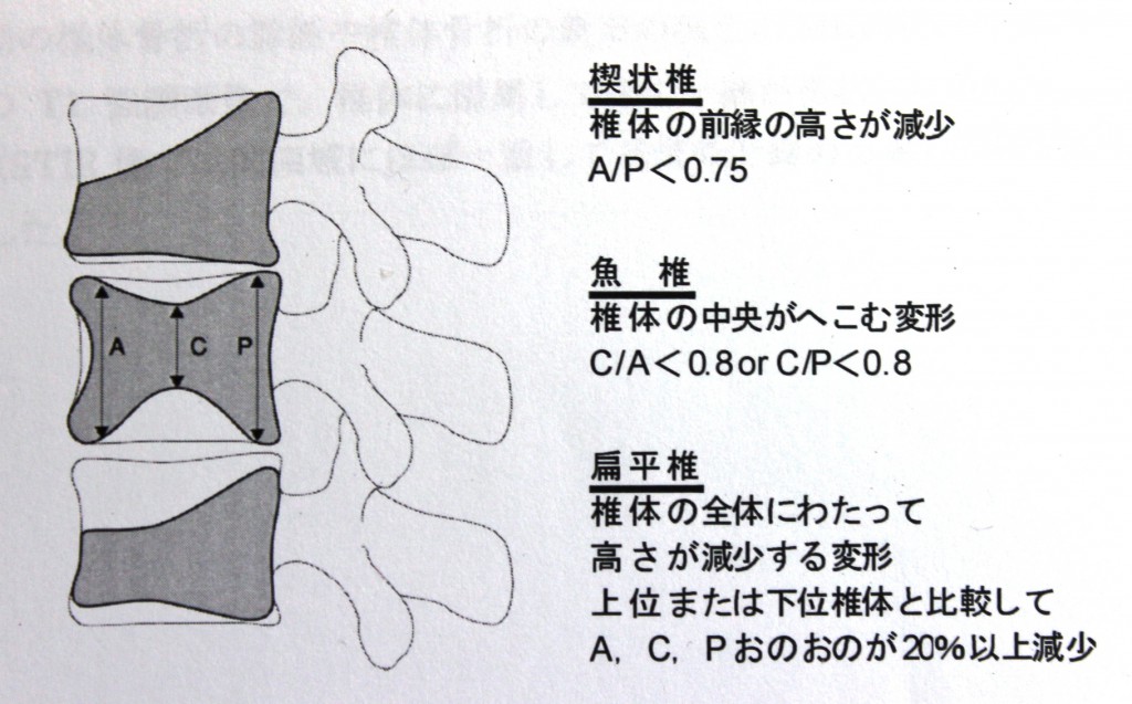 椎体骨折基準
