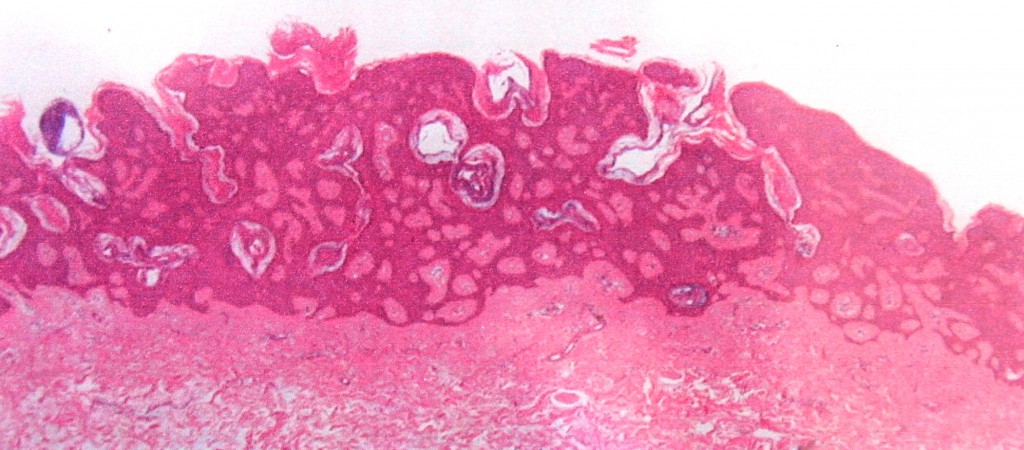 Sebaceous Hyperkeratosis TMN
