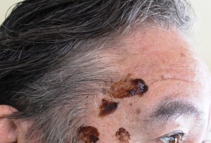 sebaseous hyperkeratosis