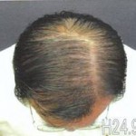 BM Hair 3m after