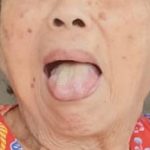 1year after treatment of melanoma with BM oil