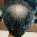 使用後1か月